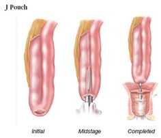 Life after surgery with a J-pouch or ileostomy bag Life after surgery with a J-pouch or ileostomy bag