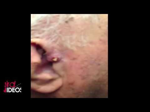 nose blackhead removal facial nerd blemish extractor