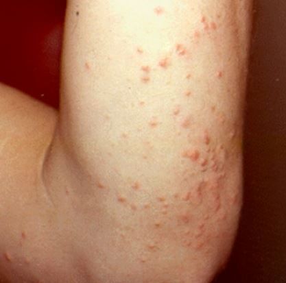 How to Treat Infant Eczema Naturally recommend How to Treat Infant Eczema Naturally recommendations
