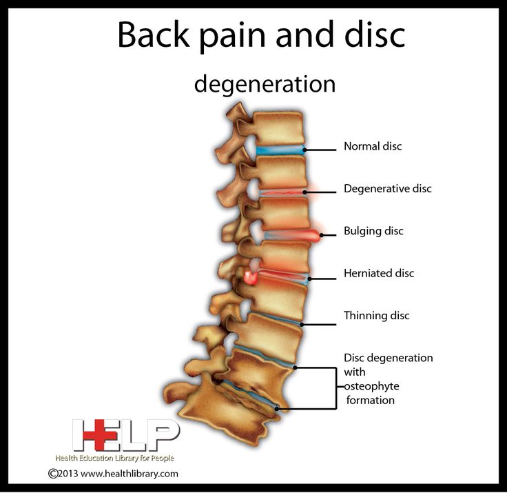 low back pain essay low back pain essay