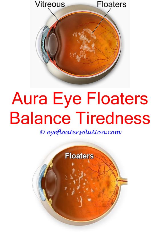 Webmd Eye Floaters Surgery And Cure
