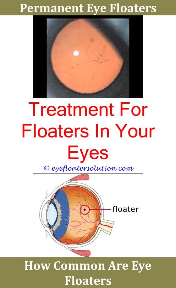 What Do Eye Floaters Mean Images Of Eye Floaters And Flashes Webmd Floater Surgery Vitreous Ayurvedic Cures For