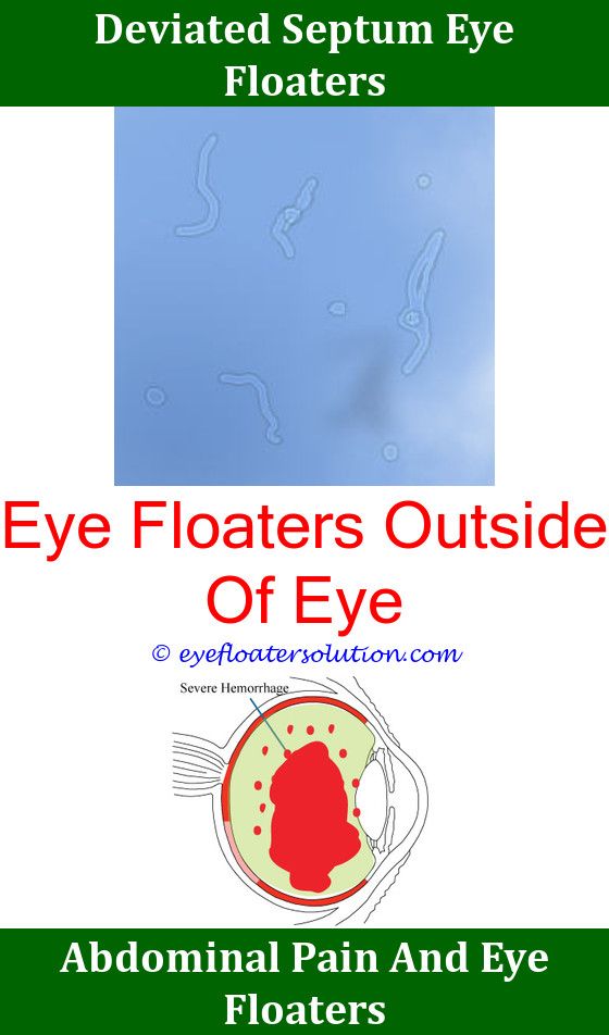 Webmd Eye Floaters Irritated Pain And Cure