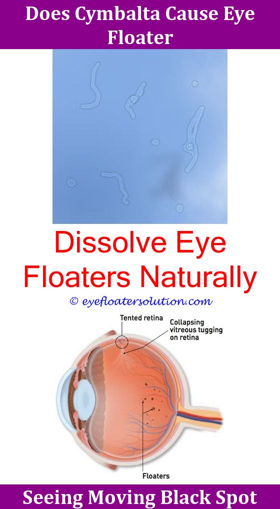 Can Any Supplements Get Rid Of Eye Floaters Ocular Migraine And Can Any Supplements Get Rid Of Eye Floaters Ocular Migraine And Webmd After Cataract Surgery St