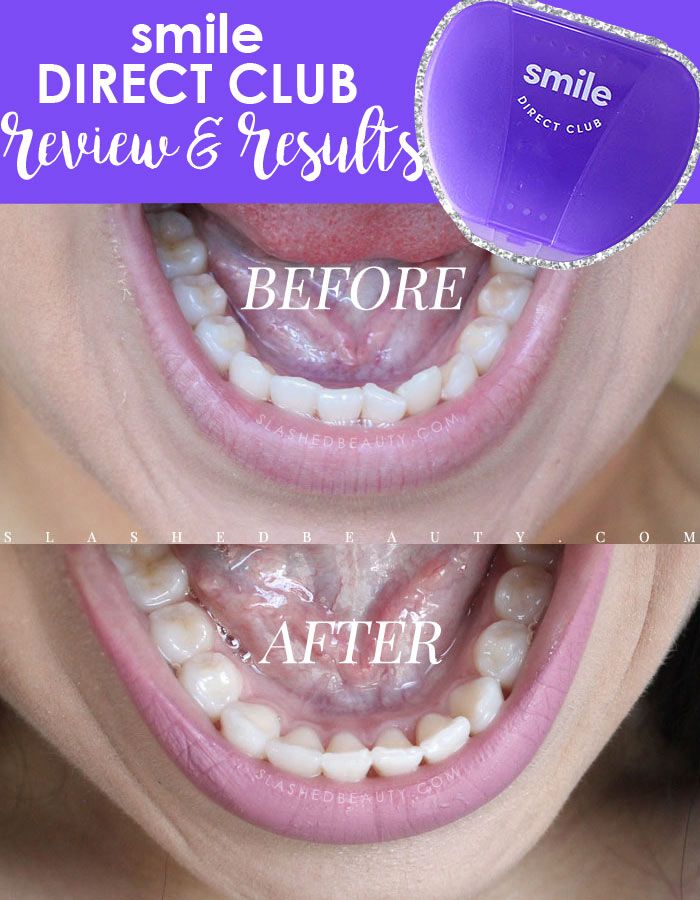 Smile Direct Club offers affordable clear braces delivered straight to your door. See my before and after, plus read the full review to see if it’s a fit. Smile Direct Club offers affordable clear braces delivered straight to your door. See my before and after, plus read the full review to see if it’s a fit.