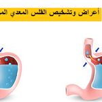الفرق بين التهاب المفصل التنكسي والتهاب المفاصل الروماتويدي Rheumatoid Arthritis Arthritis Osteoarthritis