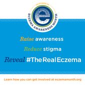 Atopic #dermatitis #plus #food #allergy #is #a #unique #subtype #of #eczema #| #National #Eczema #Association