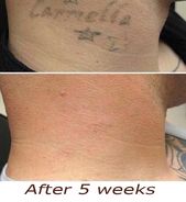 Tattoo after 5 weeks. Lemon + this ingredient can take it off. Learn more about ...