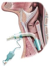 Traqueostomía Cuidados De Enfermería 2 Cuidados De Enfermería Abreviaturas De Enfermeria Enfermeras De Urgencias