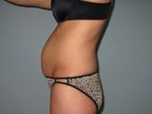 In this before and after, the weight of the fat removed was about 6 pounds. The … In this before and after, the weight of the fat removed was about 6 pounds. The …