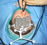 Endoscopic transsphenoidal surgery, pituitary tumor surgery