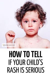 Spotty child? How to tell if your child's rash is serious. A great guide to childhood rashes by a pediatric doctor. This child has a rash typical of a viral xanthoma. #childhealth #unwellchild #unwellkid #babyrash #childhoodrashes