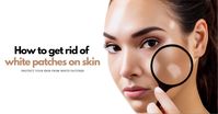 How to cure white patches on skin | Health Life News