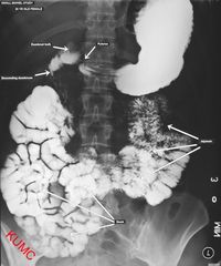 Small Bowel Series from KU Radiographic Anatomy