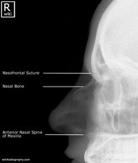 Nasal Bones - Lateral - Radiographic Anatomy
