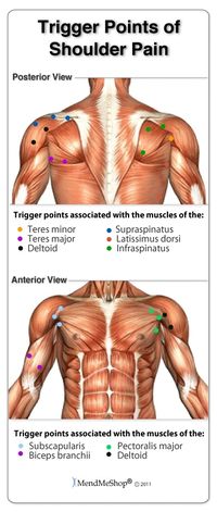The link between trigger points and frozen shoulder