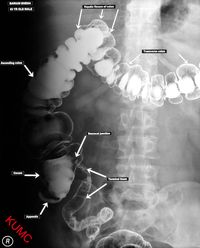 BE w/ Air and Terminal Ileum from KU Radiographic Anatomy