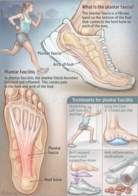 Fascitis plantar
