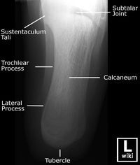 Radiographic Anatomy - Calcaneum Axial