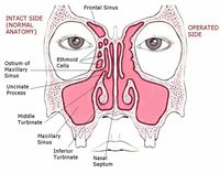 what is sinus surgery side by side