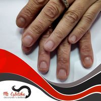 Reconstrucción de uñas mordidas. Uñas acrílicas con esmalte permanente rojo.