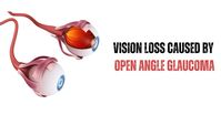 Introduction Open angle glaucoma is a chronic eye condition in which the pressure inside the eye (intraocular pressure) gradually rises, dam...