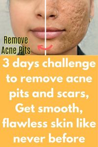 3 days challenge to remove acne pits and scars, Get smooth, flawless skin like never before Depending on how deep your scars are, you may be able to smooth them out with natural remedies. Natural remedies might take time depending on severity but they work for sure and there is no side effects. Step 1 – Scrubbing You need Sugar Lemon Rose water What to do: In a …