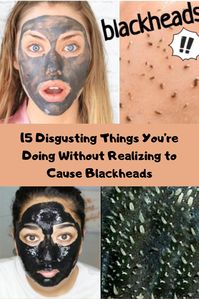 #Disgusting #Things #Blackheads #Disease #Omg #Bizzare #Fun #Entertainment #Story #Disturbing #WTF #Fact #Women #Science #Medical