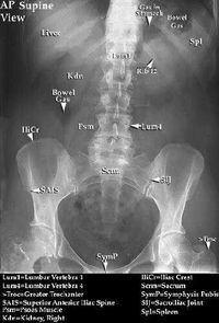 Kub X-ray labeled | What is Abdominal X-Ray or KUB?