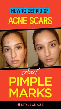 How To Get Rid Of Acne Scars And Pimple Marks #skincare #beauty #tips #acne