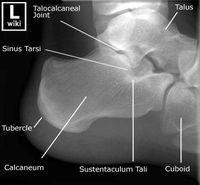 Lateral Calcaneus xray