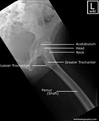 Radiographic Anatomy - Femur - Lateral - Proximal