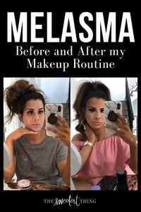 Melasma Cover, before and after my Makeup Routine. Emily Gemma, The Sweetest Thing Blog #EmilyGemma #TheSweetestThingBlog #BeforeandAfter #Melasma