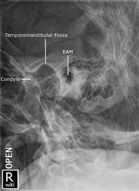 TMJ - Lateral Oblique - Open Mouth