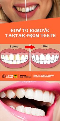 The best way to remove #tartar buildup is paying a visit to your dentist, but there are other ways to remove tartar buildup from your #teeth at home.