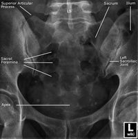 Radiiographic Anatomy - Sacrum - AP