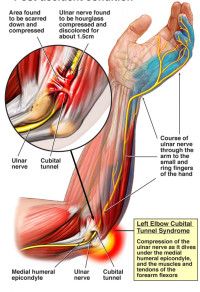 Cubital Tunnel Syndrome | Rehab & Therapy | Kleiser Therapy Hand, Arm, & Shoulder