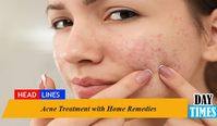Acne Treatment with Home Remedies. Acne is a kind of skin ailment. Nowadays a number of girls are facing acne due to sebum (oily) skin. Acne is not a life-threatening disease but it ruins the pretty face and leaves behind ugly acne scars.