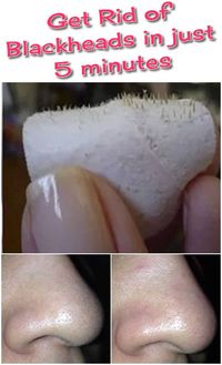 Get Rid of Blackheads in just 5 minutes