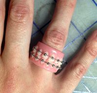 Braces Ring | Etsy