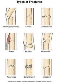 Types of bones fractures. Open, closed, compression, stress, avulsion, greenstick, transverse, comminuted, and impacted. Remember that for fractured bones, we recommend the use of a SAM Splint, a first aid item that can fit in your first aid bag; learn about this item here: http://insidefirstaid.com/personal/first-aid-kit/splinting-bone-fractures-with-a-sam-splint #emt #ems #nurse #medical #bones #broken #bones #fractures #sam #splint