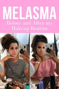 Melasma Cover, before and after my Makeup Routine. Emily Gemma, The Sweetest Thing Blog #EmilyGemma #TheSweetestThingBlog #BeforeandAfter #Melasma