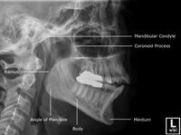 Oblique mandible