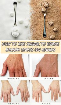 How to use sugar to erase brown spots on hands -  1/2 teaspoon of sugar * 1/2 lemon juice * Apply solution in your hands. Act 10 minutes, then rinse.