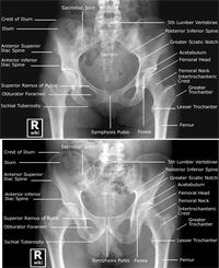 Labeled radiographic anatomy of the male (bottom image) and female (top image) pelvis.