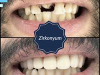 Implant Ustu Protez Dis Tedavisi Ile Eksik Olan Dislerinizin Yerine Implant Dis Yerlestirerek Agiz Sagliginizi Guvenceye Almaniz Ve E Dis Doktorlar Dis Sagligi Implant Ustu Protez Dis Tedavisi Ile Eksik Olan Dislerinizin Yerine Implant Dis Yerlestirerek Agiz Sagliginizi Guvenceye Almaniz Ve E Dis Doktorlar Dis Sagligi