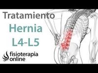 Tratamiento De La Hernia Discal L5 Y S1 Izquierda O Quinta Lumbar Y Sacro Hernia Discal Hernia Ejercicios Para Hernia Discal