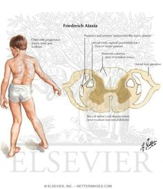 FRIEDREICH ATAXIA DOWNLOAD FRIEDREICH ATAXIA DOWNLOAD