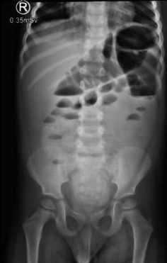 Small Bowel Radiology: Introduction and Atlas