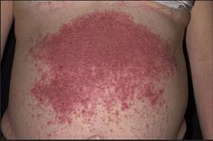 dermatitis 9 hónap